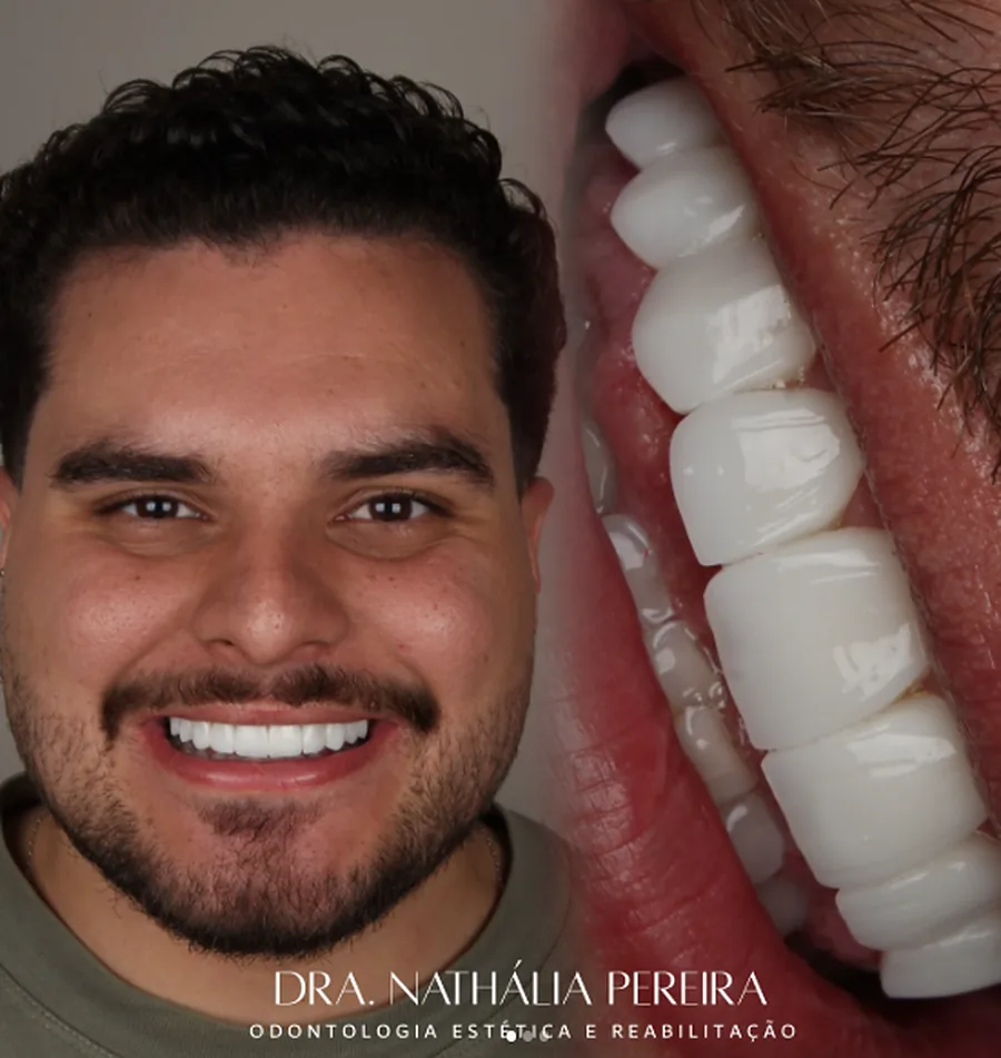 Resultado de lentes em resina — sorriso de paciente da Dra. Nathália Pereira