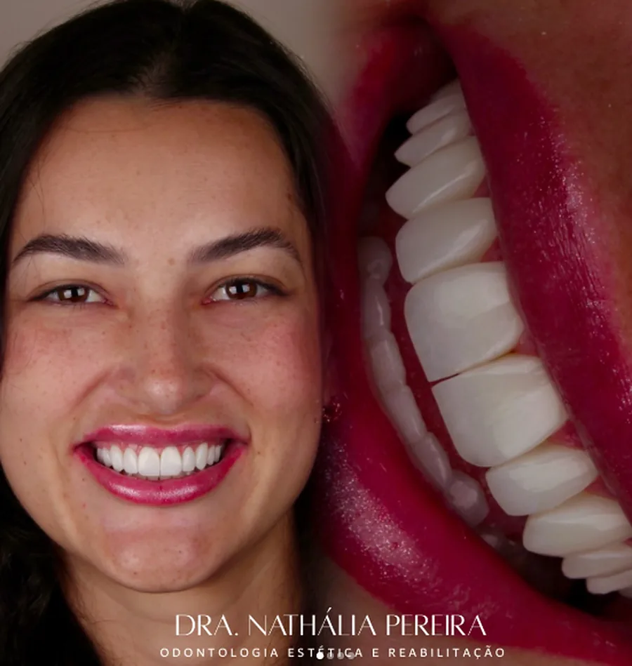 Resultado de lentes em resina — harmonização do sorriso