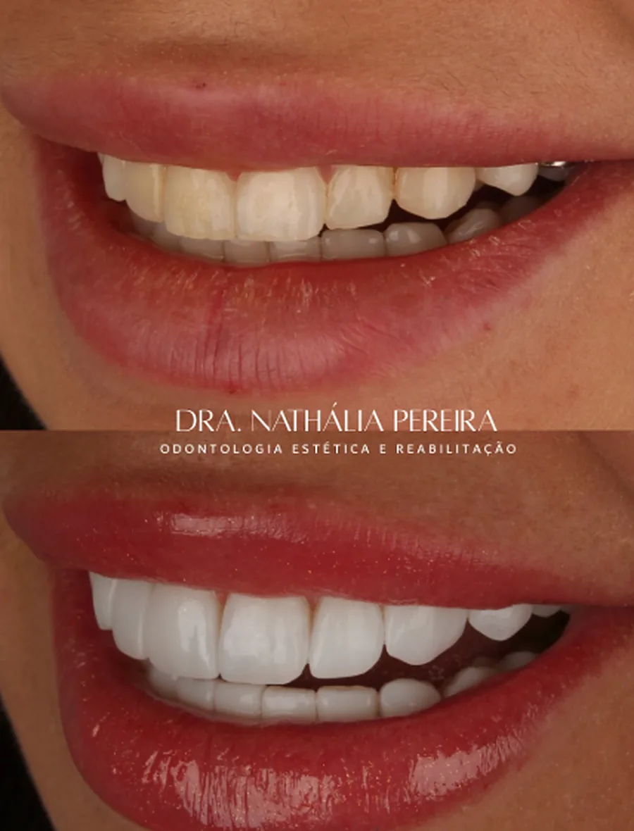Antes e depois de lentes em resina: dentes antes do tratamento acima e resultado abaixo