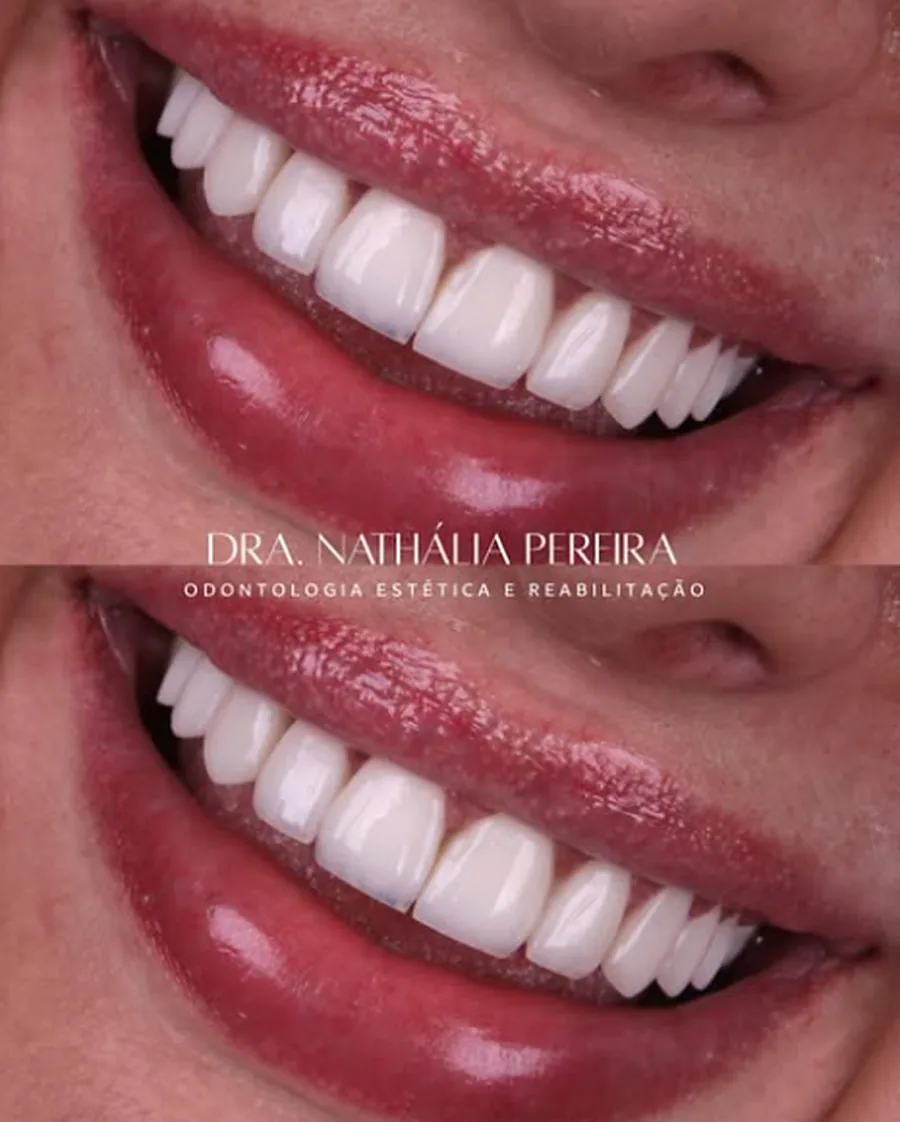 Detalhe do acabamento de lentes em resina